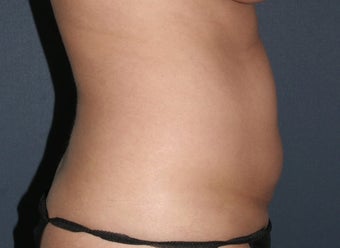 Liposculpture