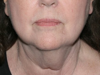 Liposculpture