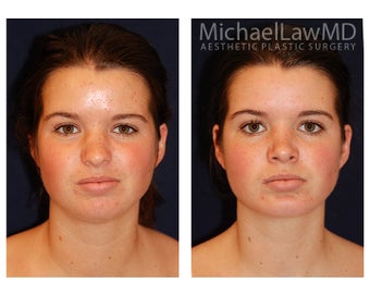 Chin Liposuction