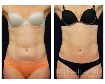 Liposuction