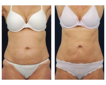 Liposuction