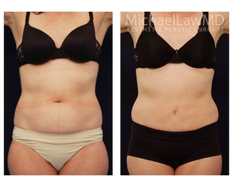 Liposuction