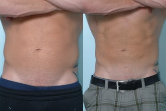 Liposculpture