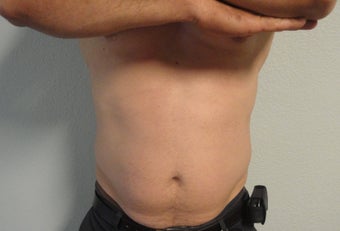 Liposuction 