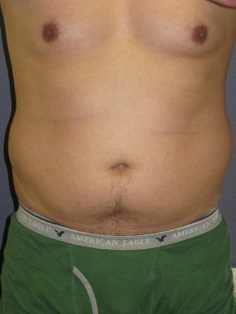 Liposuction Male