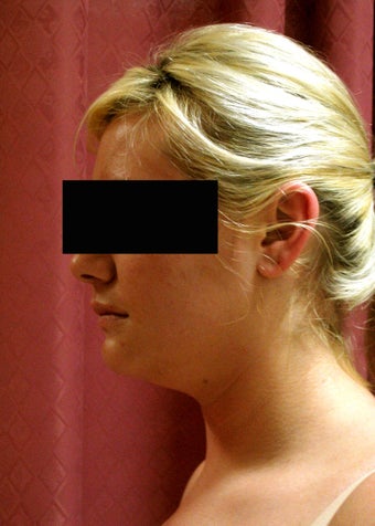 liposuction of neck & jaw line for women
