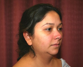 liposuction of neck & jaw line for women in Los Angeles