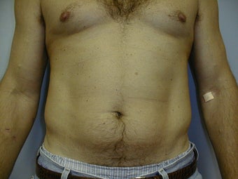 Male contouring liposuction
