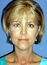 Liposuction