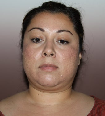 Lipocontouring of the neck