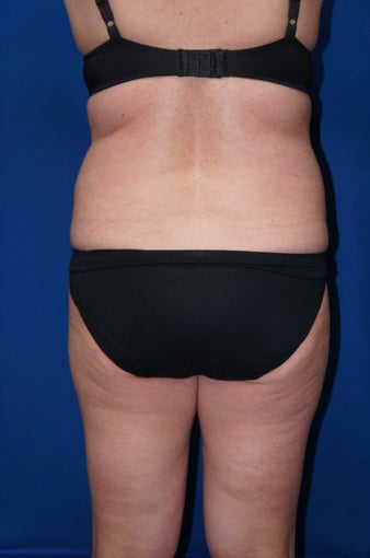 Liposuction