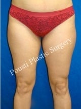  Liposuction