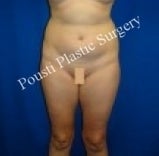 Liposuction