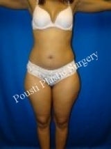 Liposuction