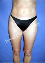  Liposuction