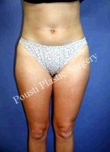 Liposuction