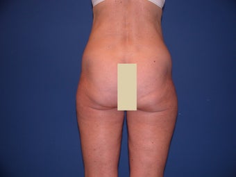 Thigh Liposculpture