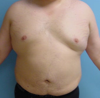 Male liposuction/liposculpture