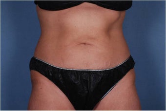 Liposonix to Abdomen