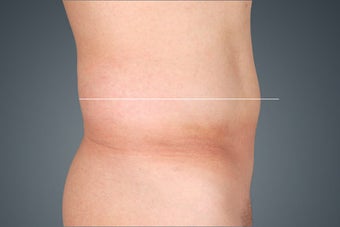 Liposonix