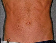 Liposonix