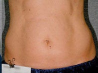 Liposonix