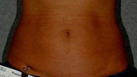 Liposonix