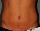 Liposonix