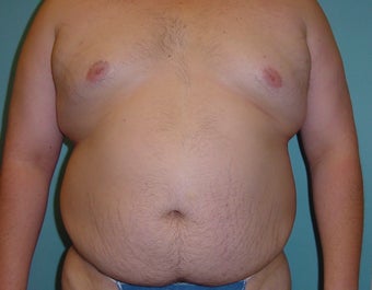 Male liposuction/liposculpture