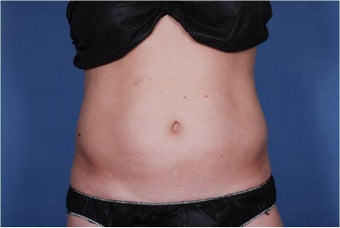 Liposonix