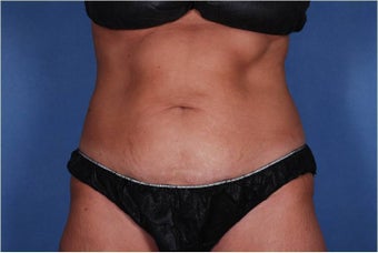 Liposonix to Abdomen