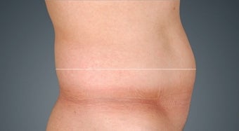 Liposonix