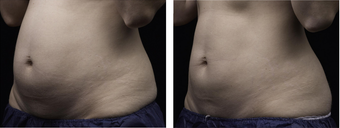 liposonix