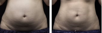 LIPOSONIX