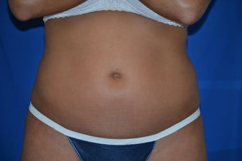 Liposonix
