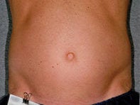 Liposonix