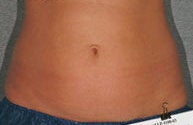Liposonix