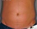 Liposonix
