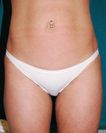 Liposuction