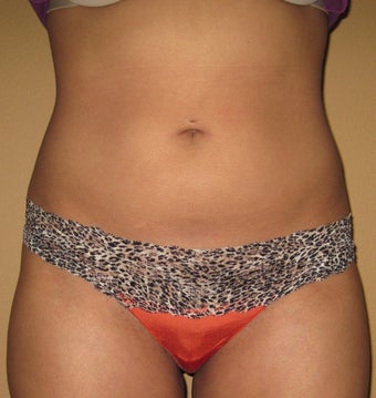 liposuction