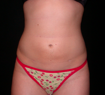 Liposuction