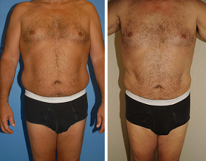 Male Liposuction