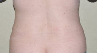 Liposuction