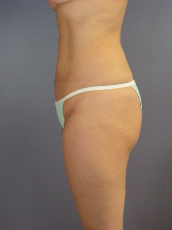 Liposuction of the hips, flanks, and thighs.