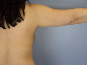 Liposuction of the arms