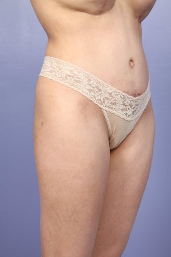 Liposuction: Thighs, Hips, and Abdomen 