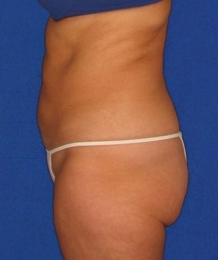 Liposuction, SmartLipo™