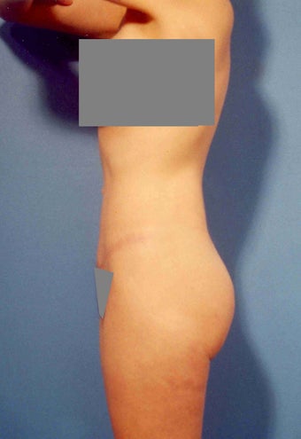 Abdominoplasty