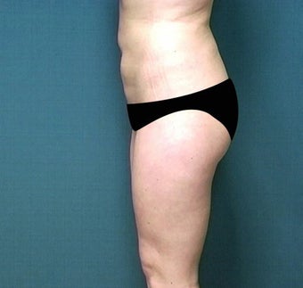 Liposuction