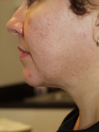 Liposuction Neck